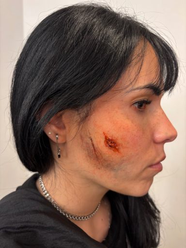 Scar/Cut/Bruise: After