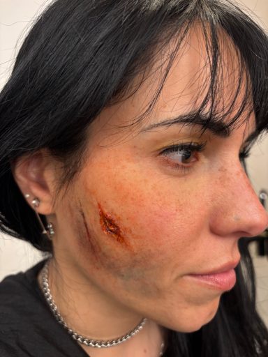 Scar/Cut/Bruise: After