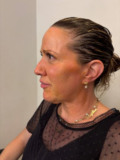 Sun Exposure: Before