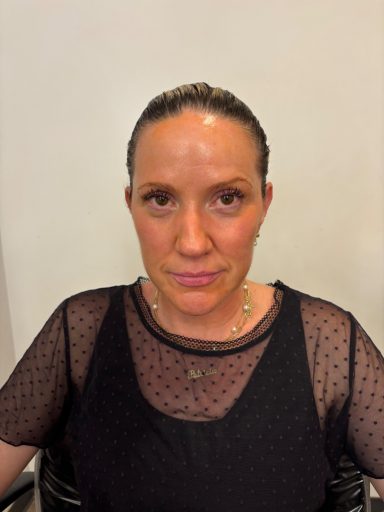 Sun Exposure: Before