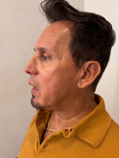 Model 1: Before - Lace Piece