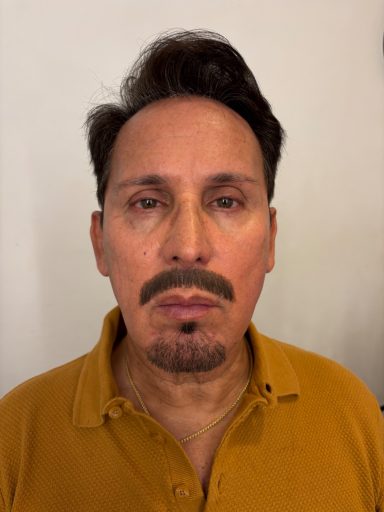 Model 1: After - Lace Piece