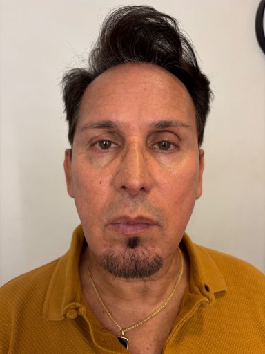 Model 1: Before - Lace Piece