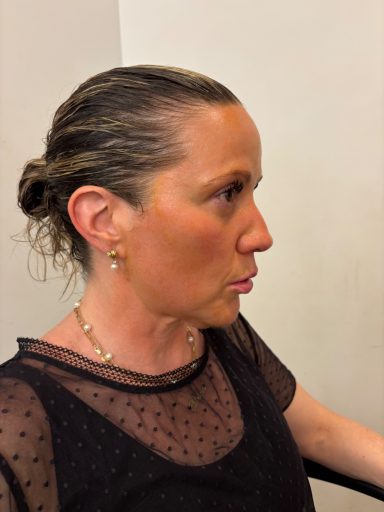 Sun Exposure: Before