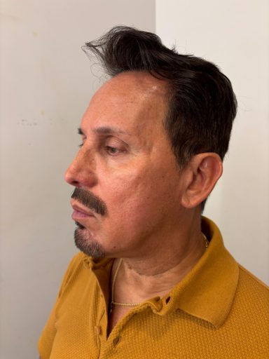 Model 1: After - Lace Piece