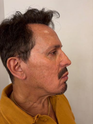 Model 1: After - Lace Piece